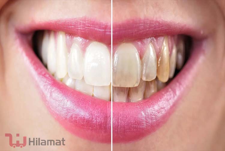 7 روش های خانگی سفیدشدن دندان