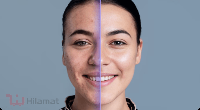 کرم گاتیو برای لک صورت کرم گاتیو برای لک صورت