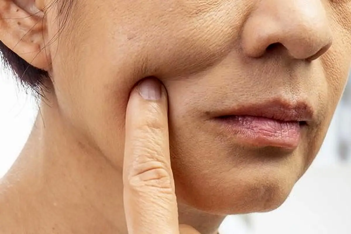 پوست شل